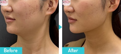 オンダリフト・オンダリフトボディ 症例写真