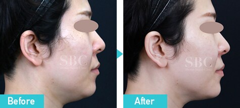 山参注射 症例写真 ビフォーアフター