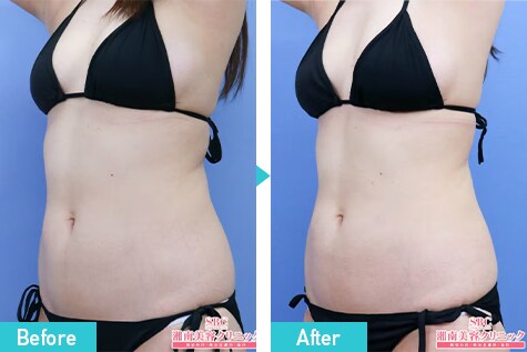 サクセンダ 症例写真 ビフォーアフター