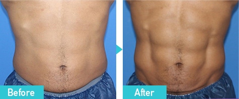 トゥルースカルプflex 症例写真 ビフォーアフター