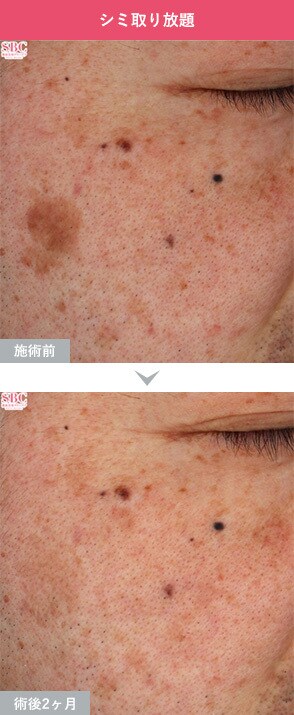 症例写真1