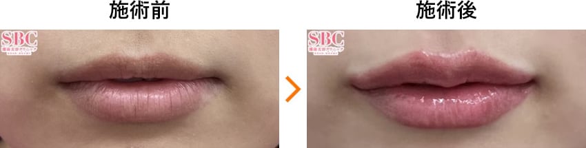 唇ヒアルロン酸 症例写真 術直後 Before After