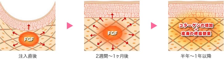 肌再生fgf注入療法 若返り エイジングケアなら湘南美容クリニック 公式