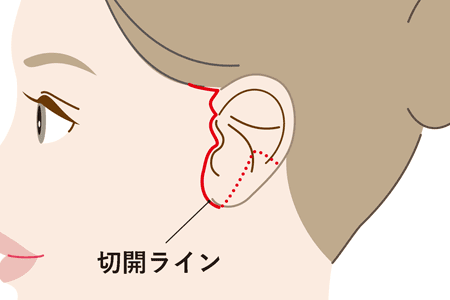 フェイスリフト(切開リフト)は傷跡が目立たない！