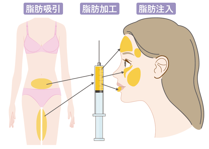 脂肪注入とは