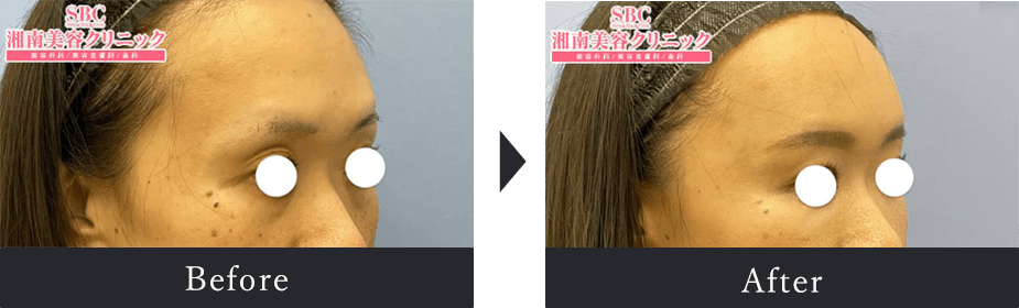 Before After