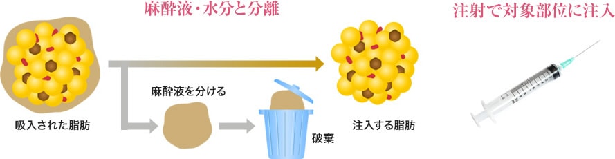 ナチュラル脂肪注射(お顔の脂肪注入)って？