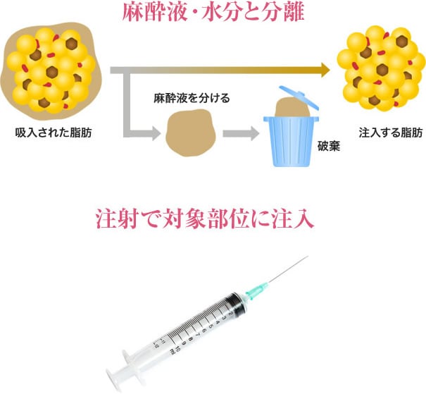 ナチュラル脂肪注射(お顔の脂肪注入)って？