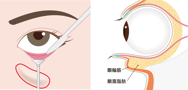 下まぶたの裏を切開