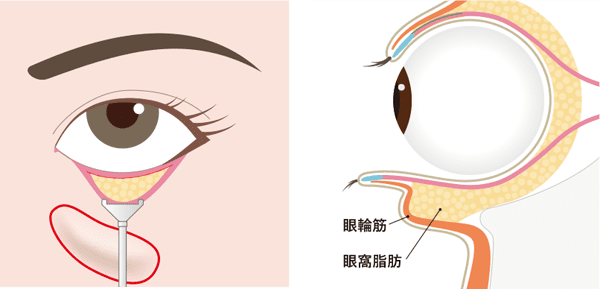 眼窩脂肪を調整