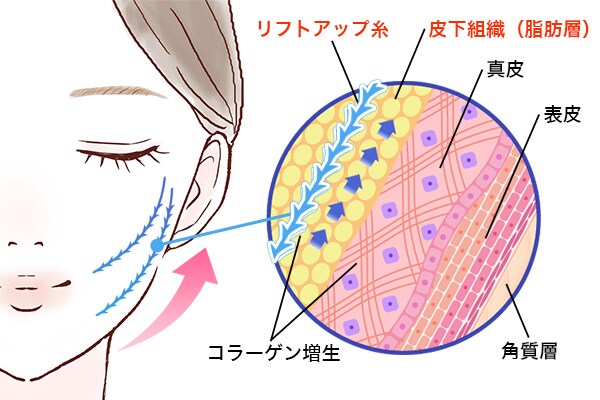 糸リフトとは