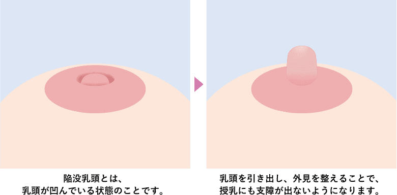 陥没乳頭治療とは