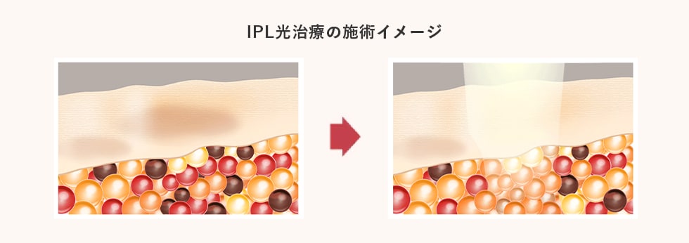 IPL光治療の施術イメージ