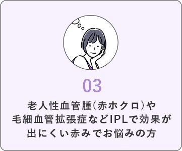 Ｖビームがおすすめの方