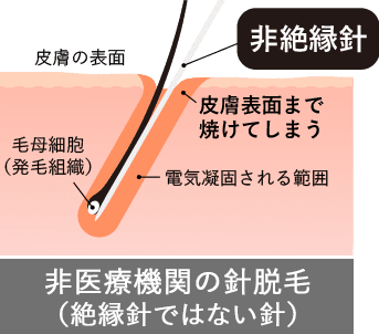 非医療機関の針脱毛（絶縁針ではない針）