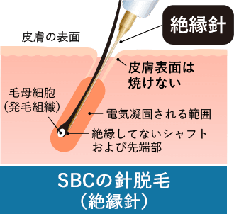 SBCの針脱毛（絶縁針）