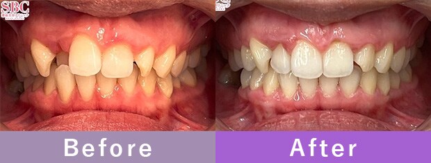 湘南マウスピースの症例写真