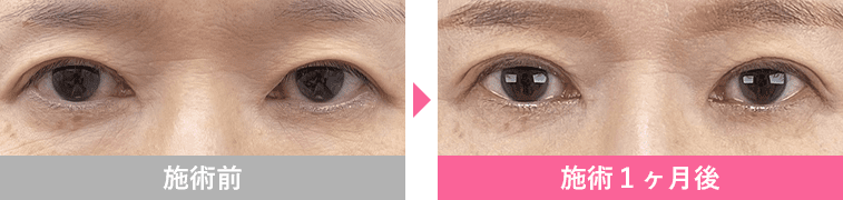 切らないまぶたのリフトアップの症例写真2