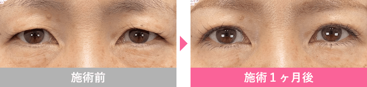切らないまぶたのリフトアップの症例写真3