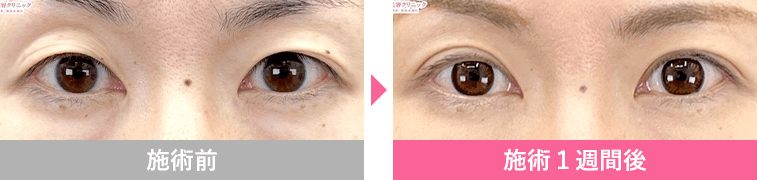 切らないまぶたのリフトアップの症例写真1