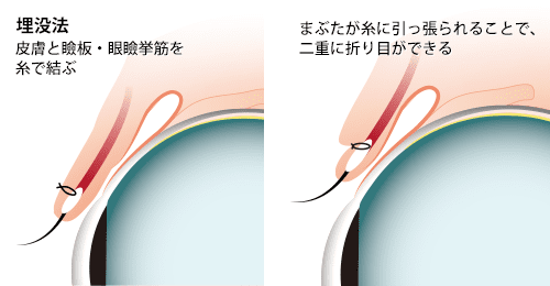 自然な二重まぶたに近い構造をもつのが埋没法