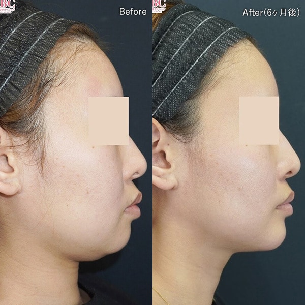 フェイスライン