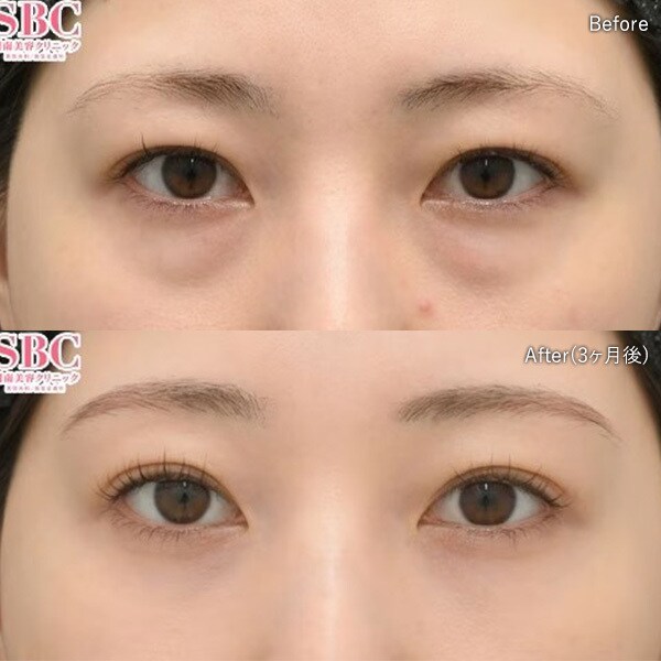 目の下の切らないクマ取り・たるみ(ふくらみ)取り