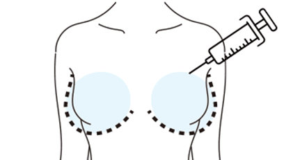 採った脂肪を胸に注入