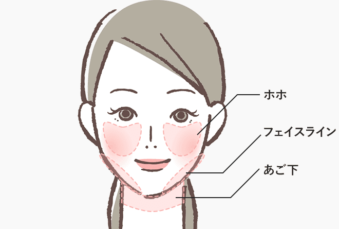 ほほ・フェイスライン・二重あごの脂肪に効果的な治療