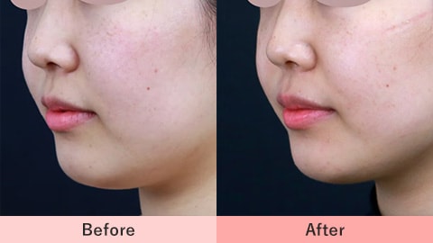 新・脂肪溶解リニアハイフの症例写真