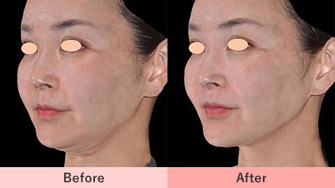 ウルトラリフトプラスHIFUの症例写真