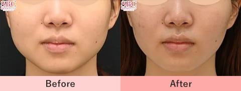 エラボトックス注射の症例写真