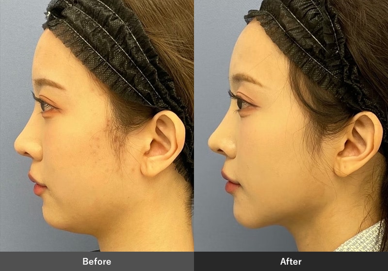 小顔治療のピックアップ症例01