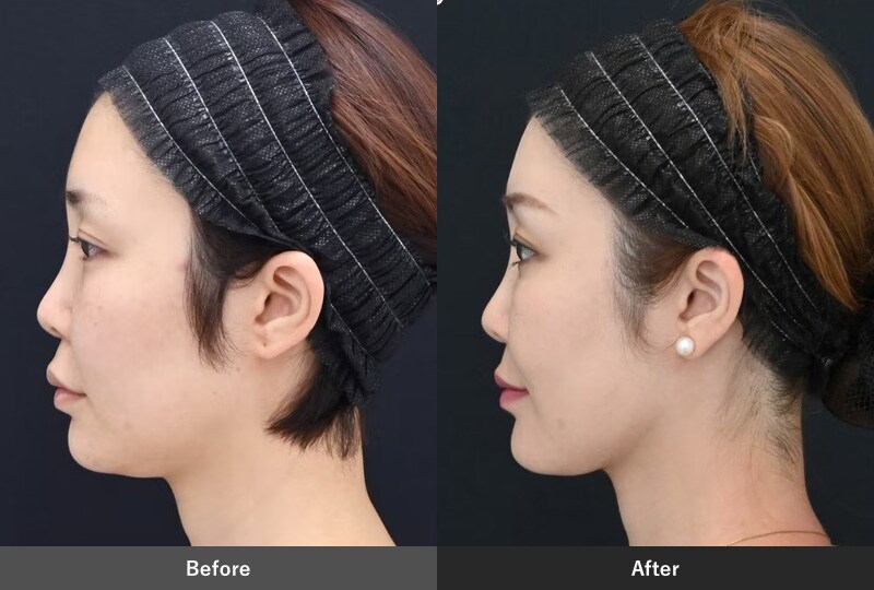 小顔治療のピックアップ症例02