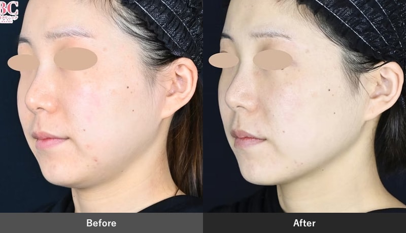 小顔治療のピックアップ症例03