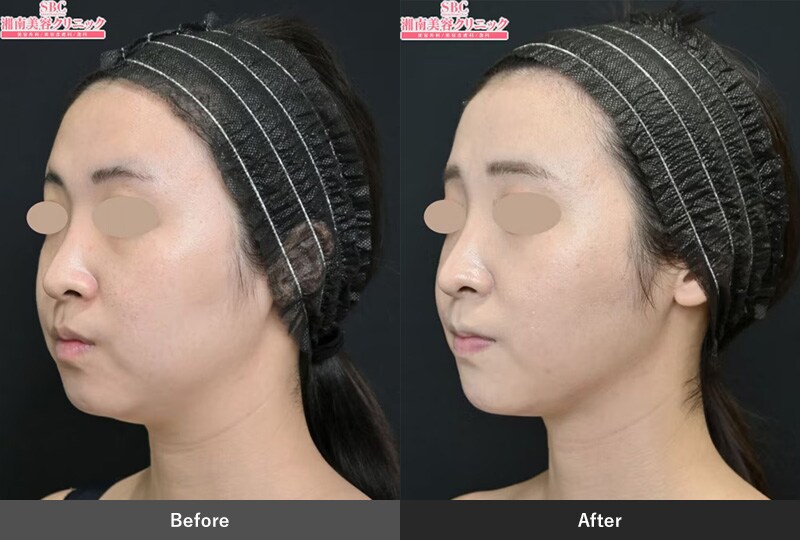 小顔治療のピックアップ症例04