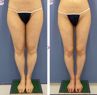 太ももAquicell(アキーセル)症例2