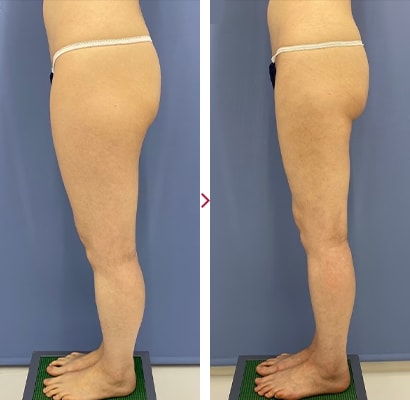 太ももAquicell(アキーセル)症例2