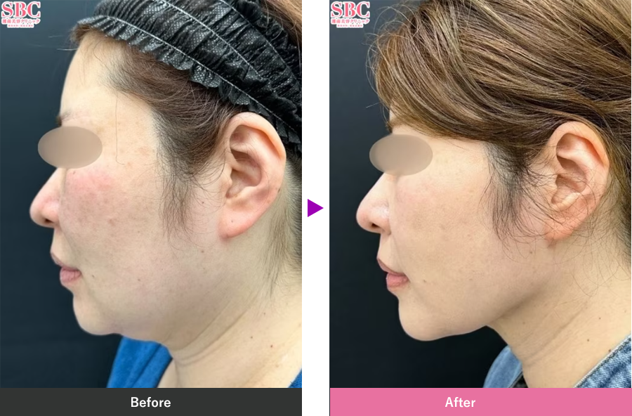 顔の脂肪吸引の症例写真