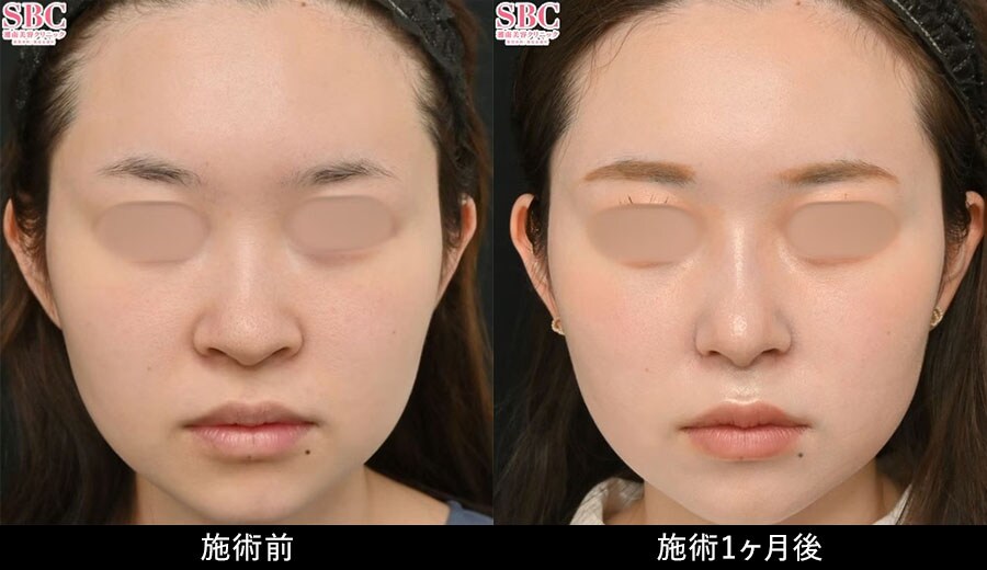 鼻フル忘れ鼻セット症例写真