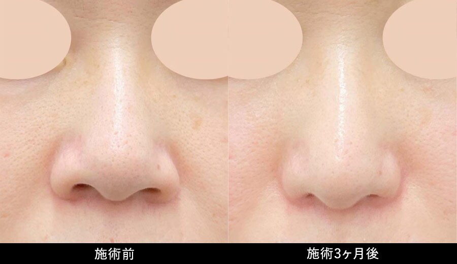 鼻フル忘れ鼻セット症例写真