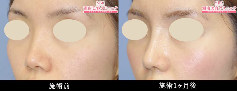 鼻フル忘れ鼻セット症例写真