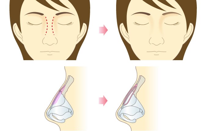 鼻骨骨切り術 鼻整形なら湘南美容クリニック 公式