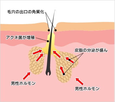 ニキビ ニキビ跡治療 美容皮膚科なら湘南美容クリニック 公式