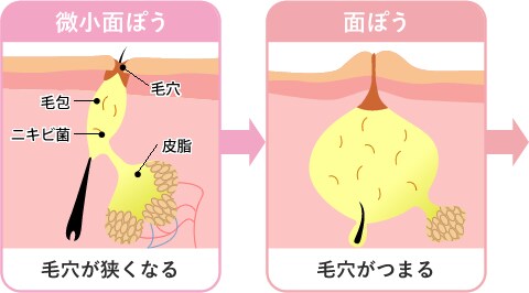 ニキビ ニキビ跡治療 美容皮膚科なら湘南美容クリニック 公式