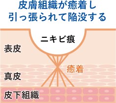 皮膚組織が癒着