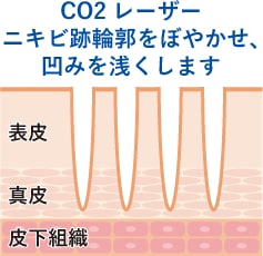 医療用針で切断