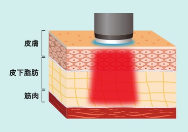 世界初のマイクロ波で脂肪層にピンポイントアプローチ イメージ