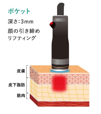 顔用ハンドピース イメージ2