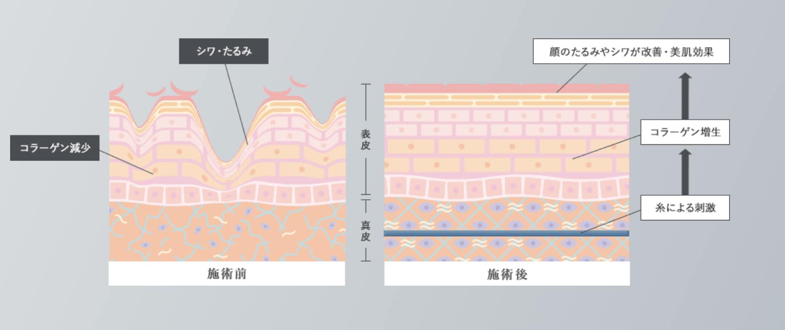 なぜたるみに効果的なの？